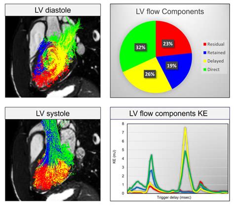 lv ke|Evaluation of left ventricular blood flow kinetic energy in patients .